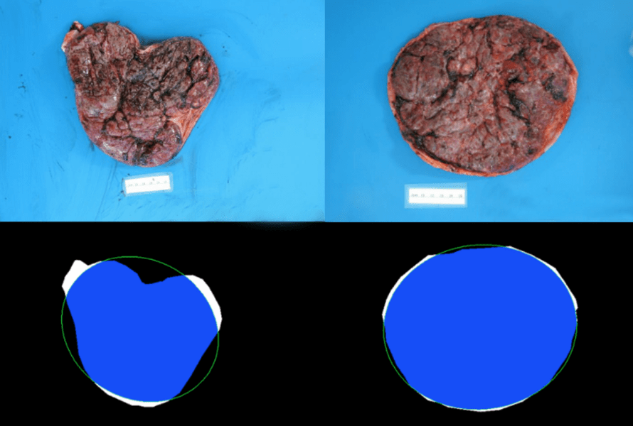 Normal and Abnormal shape placenta