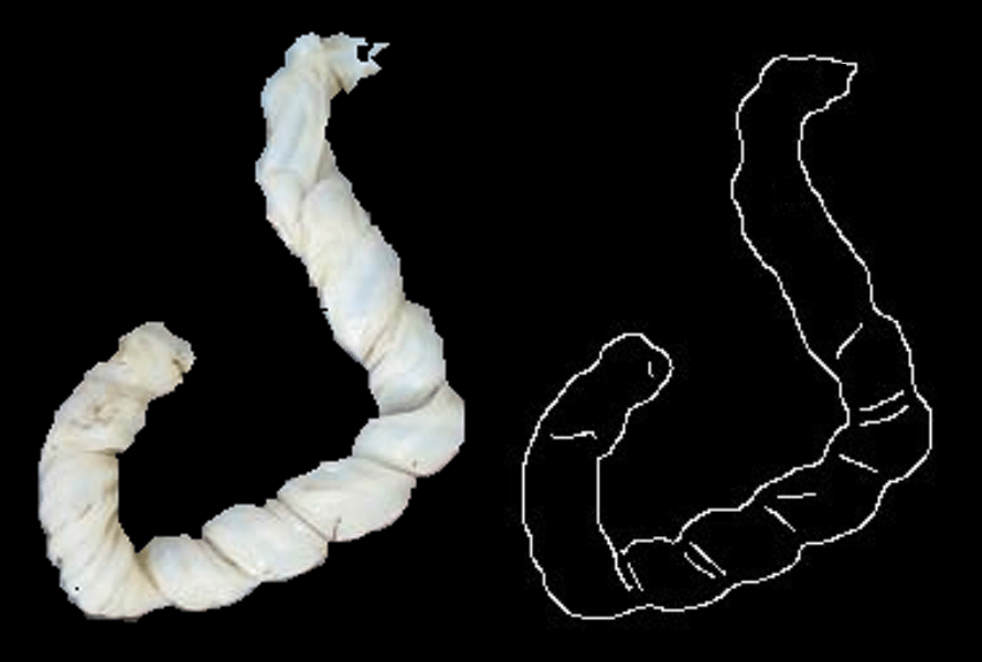 Hypercoiled umbilical cord